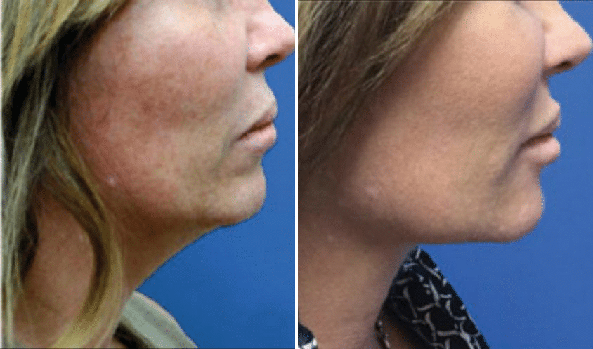 Skin Tightening With Thermitight